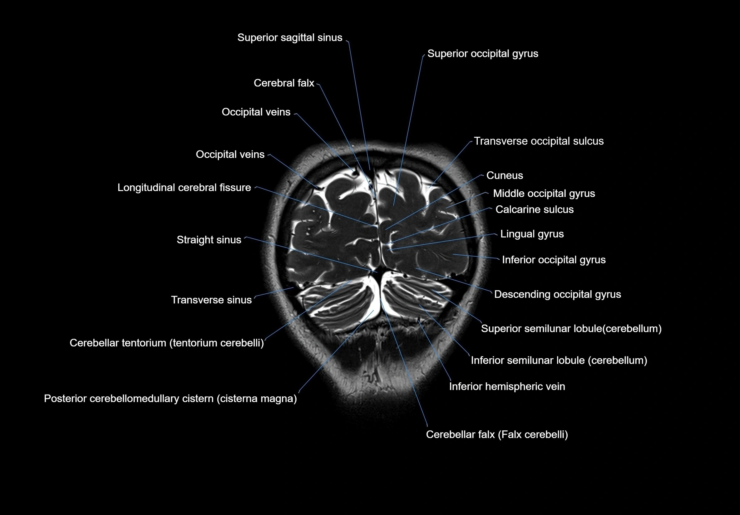 MRI Brain coronal cross sectional labelled anatomy 3T image  -img-00001-00065.webp